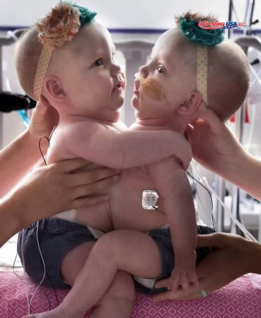 These Conjoined Sisters Were Born Fused at the Chest and Stomach